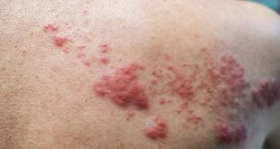 More than chickenpox what you should know about shingles